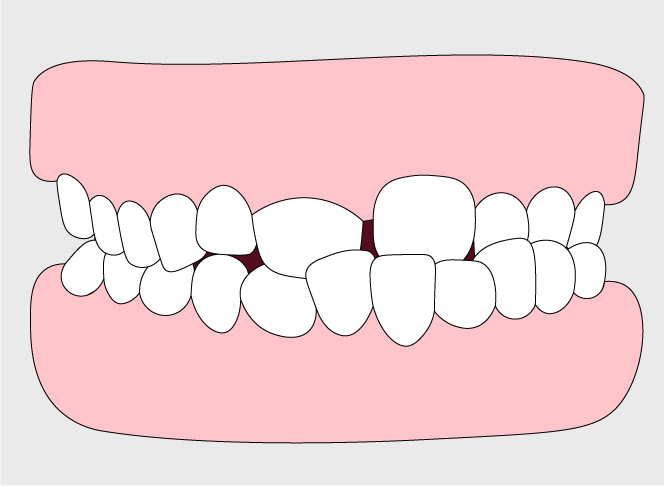 Anterior Crossbite | Orthodontic Care in Gillette, WY