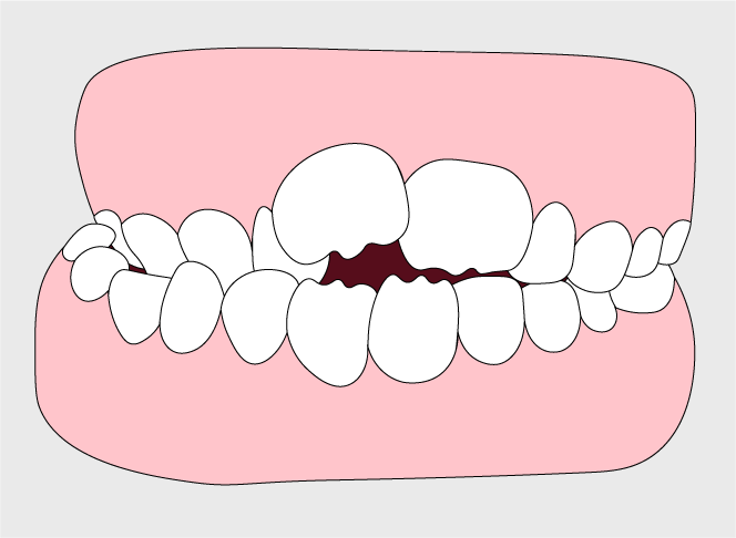 Crossbite | Orthodontic Care in Gillette, WY