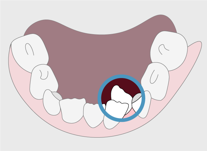 Tooth Crowding | Orthodontic Care in Gillette, WY