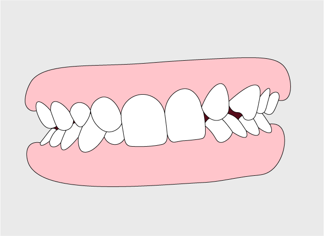 Deep Bite | Orthodontic Care in Gillette, WY