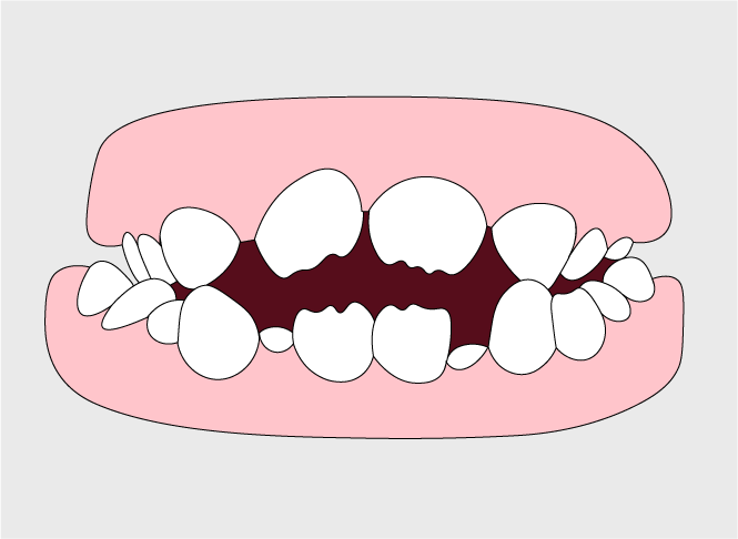 Open Bite | Orthodontic Care in Gillette, WY