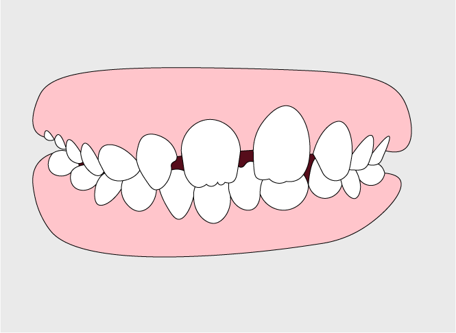 Tooth Spacing | Orthodontic Care in Gillette, WY