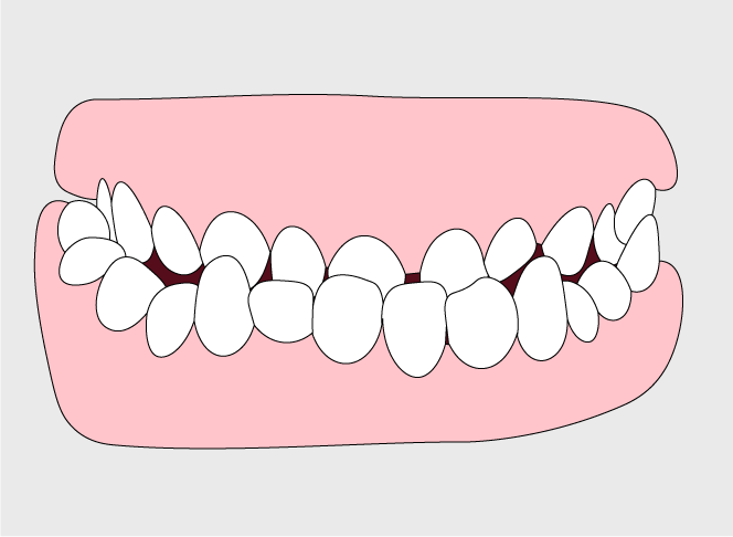 Underbite | Orthodontic Care in Gillette, WY